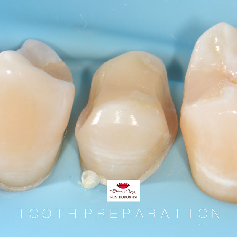 陶瓷嵌體 - 3D齒雕 案例分享 -新竹光明牙醫