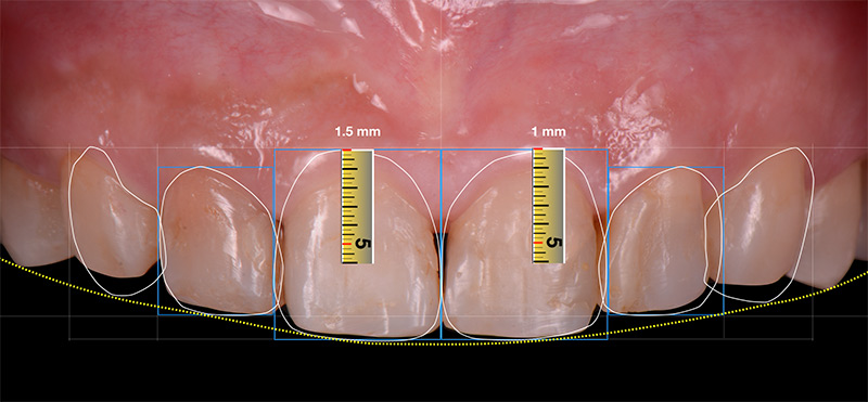 數位微笑設計_牙齦整形需切削的量 - 前牙陶瓷貼片案例分享 - 新竹光明牙醫