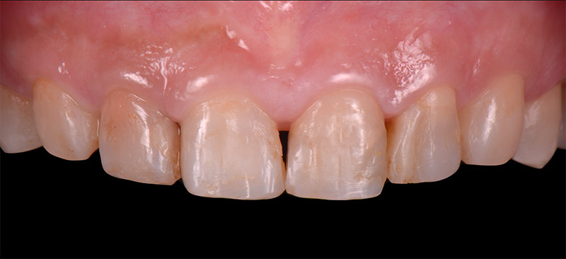 治療前-前牙DSD數位微笑設計-新竹光明牙醫