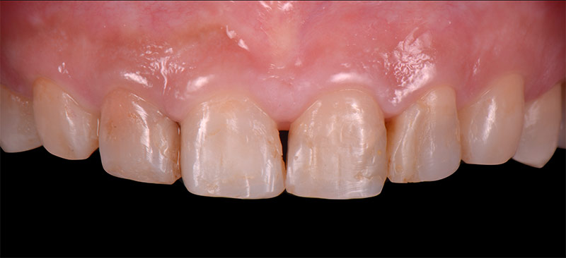 治療前 - 前牙陶瓷貼片案例分享 - 新竹光明牙醫