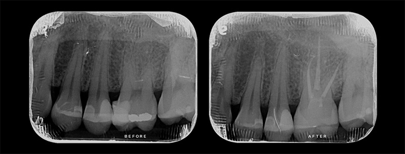 治療前後x光片 - 陶瓷嵌體:3D齒雕新竹光明牙醫案例分享 