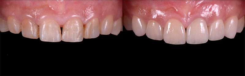 治療前後之比較-前牙DSD數位微笑設計-新竹光明牙醫
