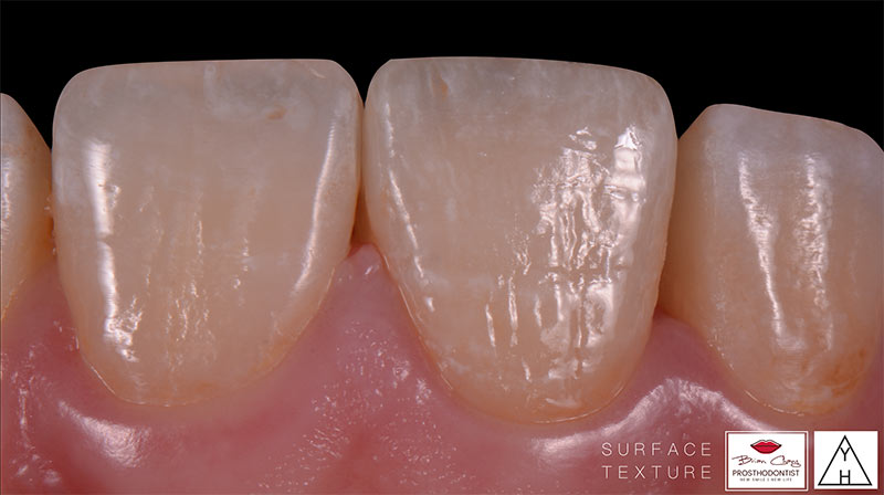 治療後 - 前牙陶瓷貼片 - 新竹光明牙醫
