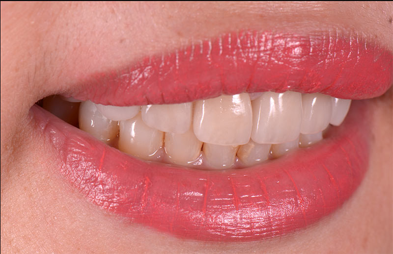 治療後的笑容_仿真的全瓷冠及貼片 - 前牙陶瓷貼片案例分享 - 新竹光明牙醫