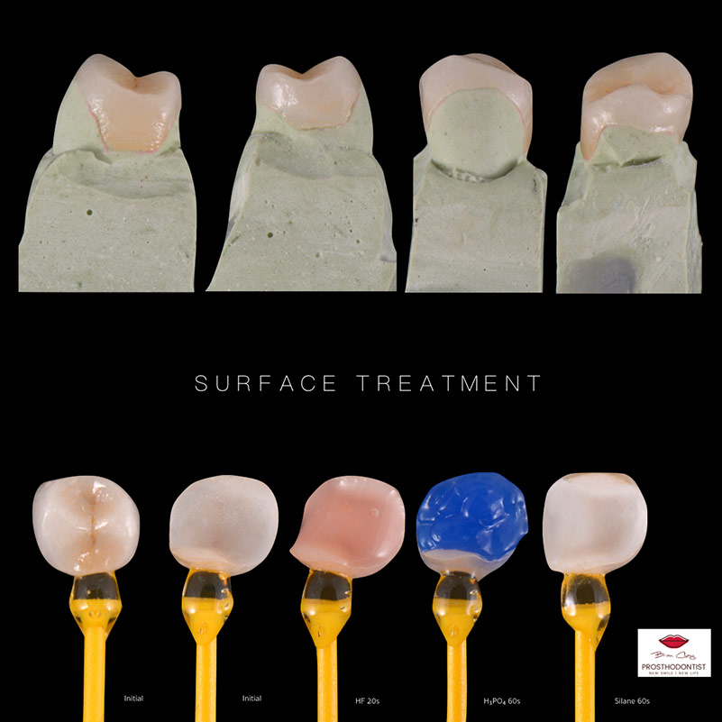 陶瓷嵌體 - 3D齒雕 案例分享 -新竹光明牙醫