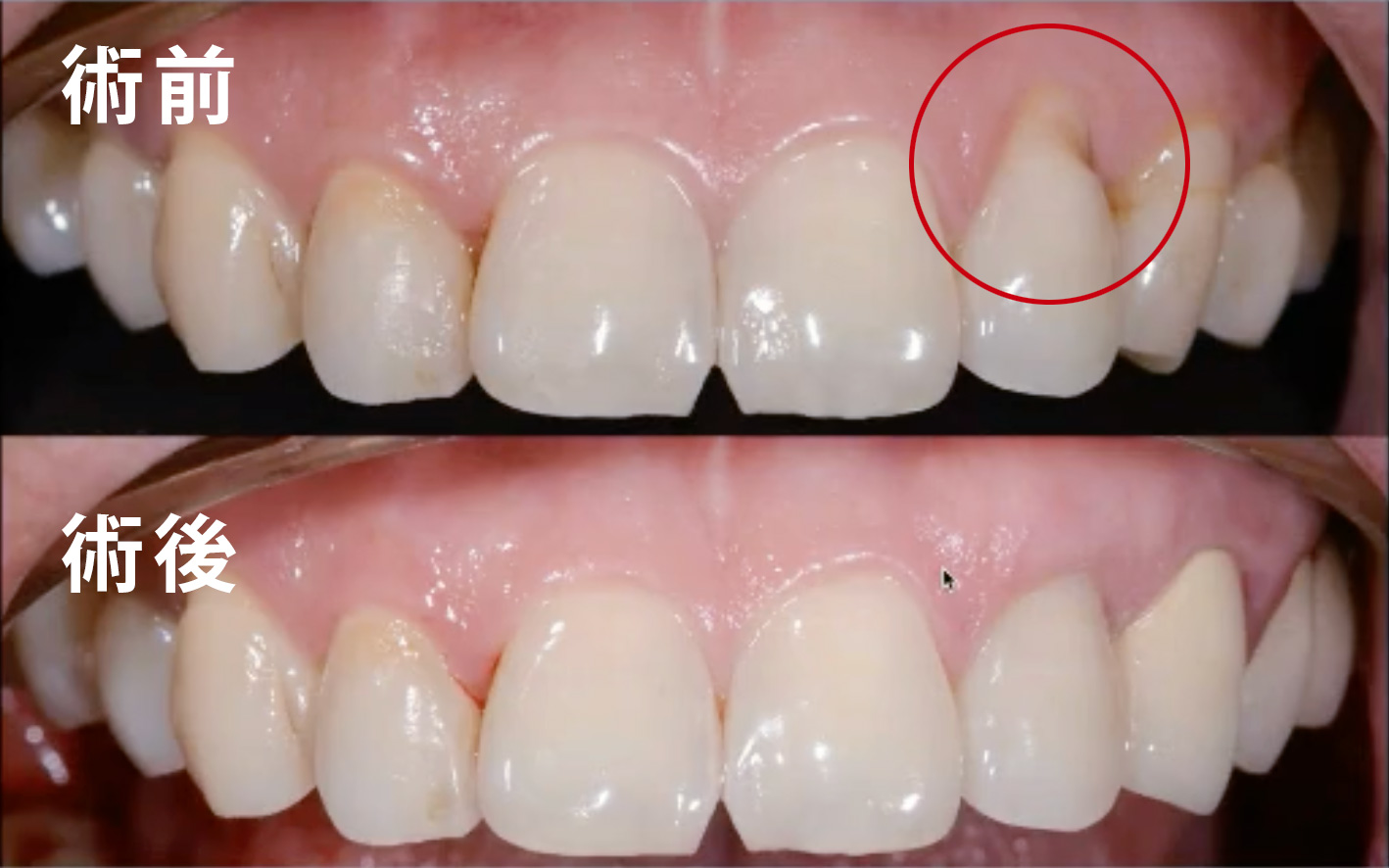 牙槽骨萎缩 填充骨粉骨膜 牙龈翻瓣手术 的亲身经历（一） - 知乎