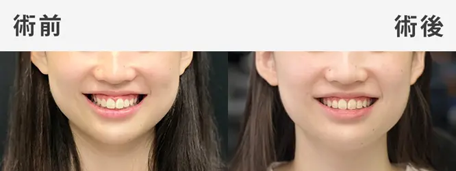 Read more about the article 隱適美案例-廖小姐