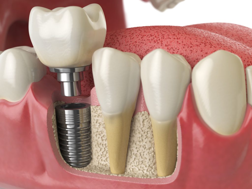 anatomy of healthy teeth and tooth dental implant 2021 08 26 16 56 57 utc