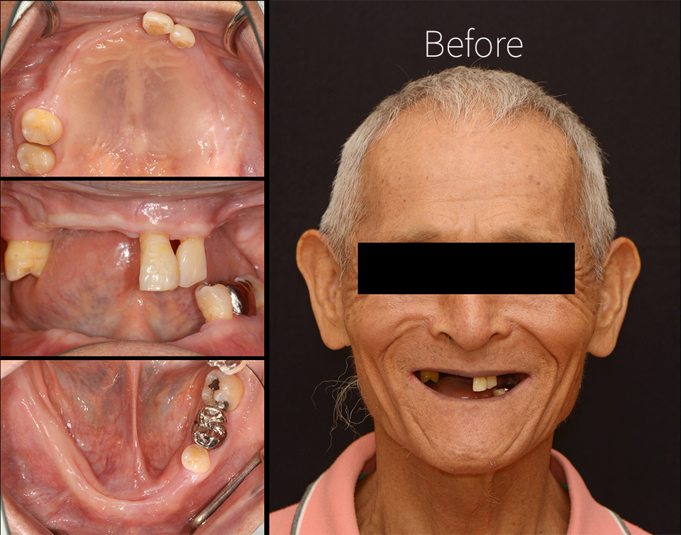 drbrian denture case2 1