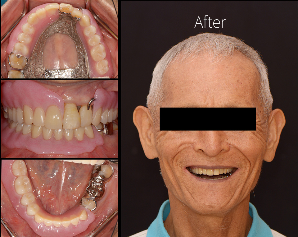 drbrian denture case2 2