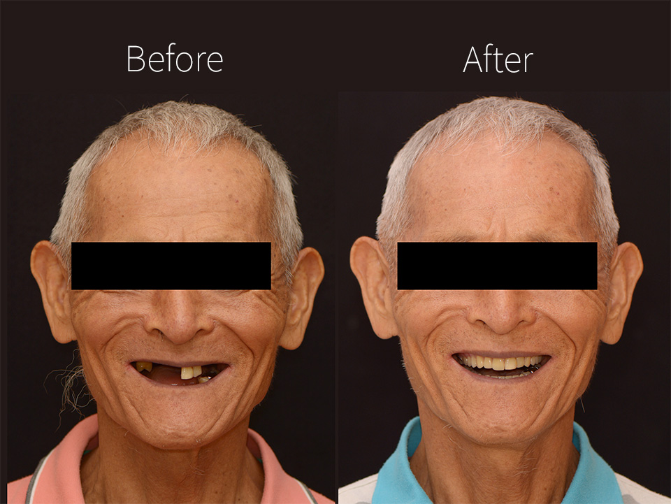 drbrian denture case2 3