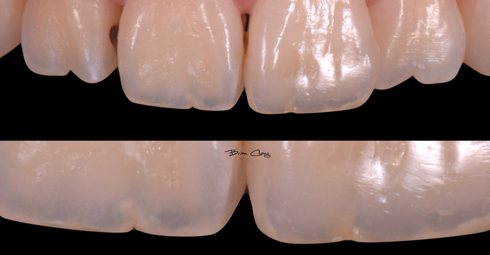 Read more about the article 前牙奈米樹脂填補案例03