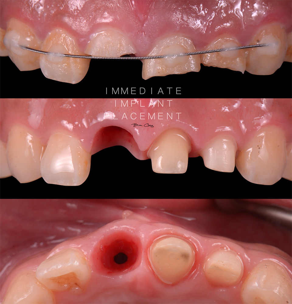 drbrian implant case1 3