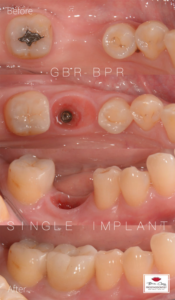 drbrian implant case2 1