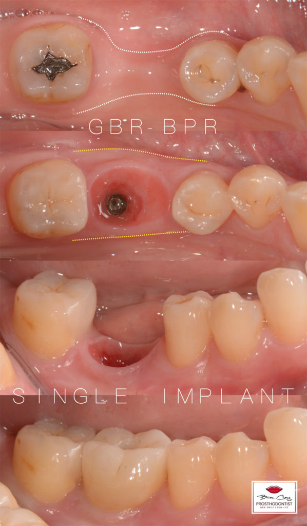 drbrian implant case2 3