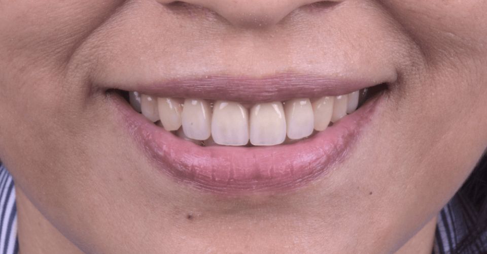 DSD數位微笑設計案例牙冠增長術前牙四顆全瓷冠05