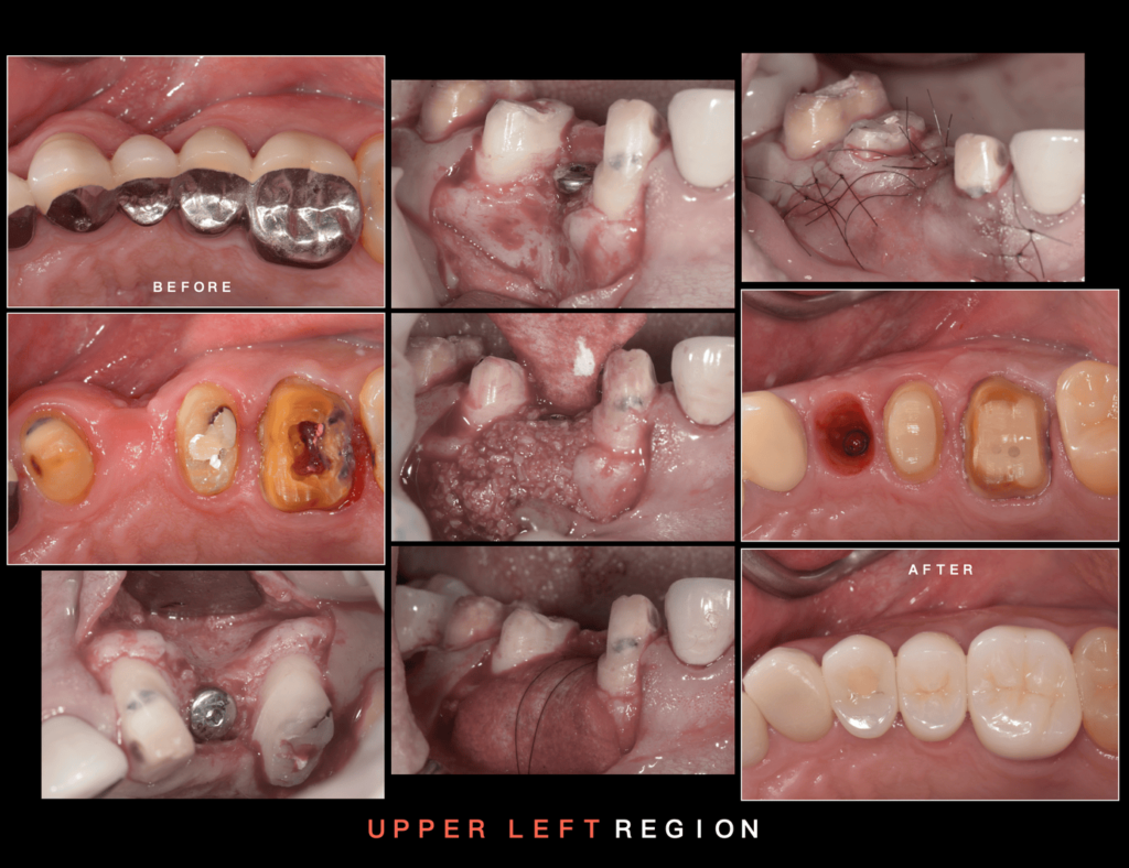 左上進行補骨植牙手術 從術前到術後c