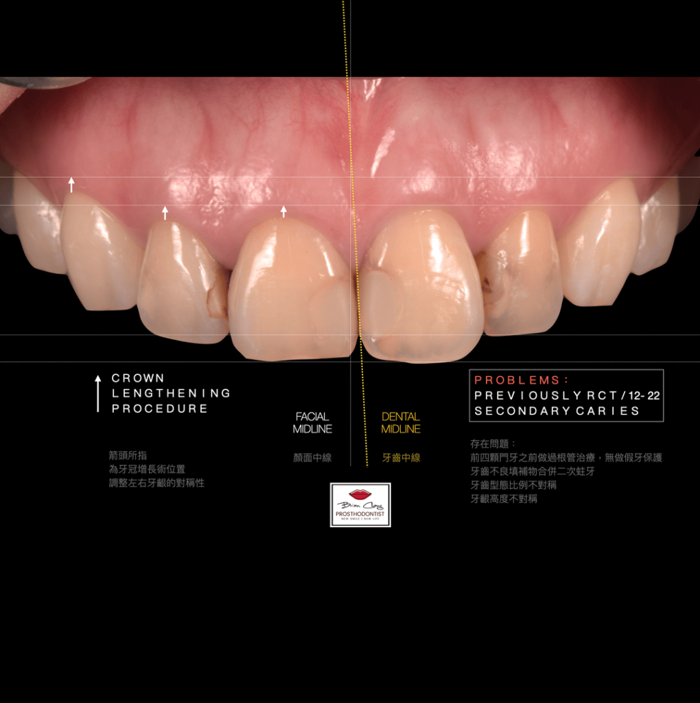 治療前 牙齒與軟組織的分析c