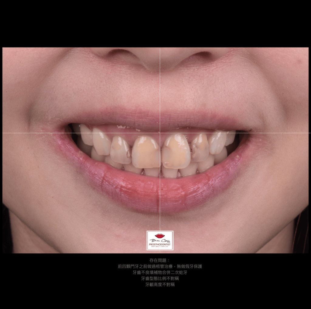 治療前 笑容與牙齒的關係分析c