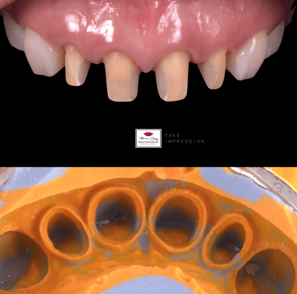 精準印模 可清晰看到牙齒的邊界，才能做出精準的假牙c