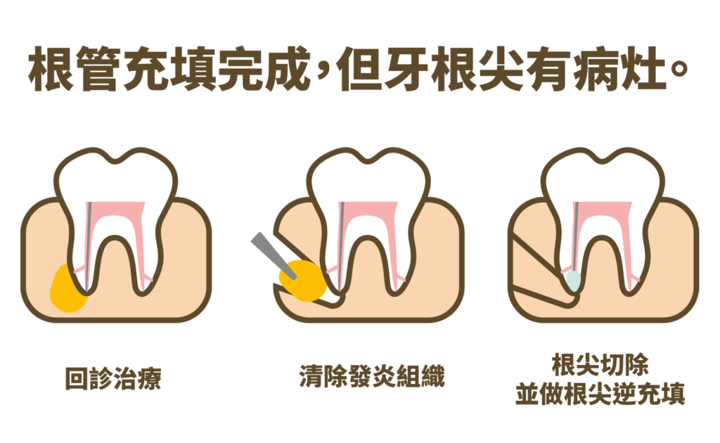 根管治療 29 根管充填完成，但牙根尖有病灶