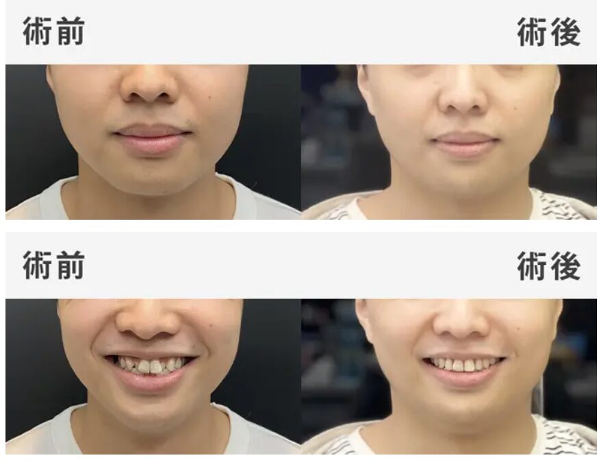 矯正案例