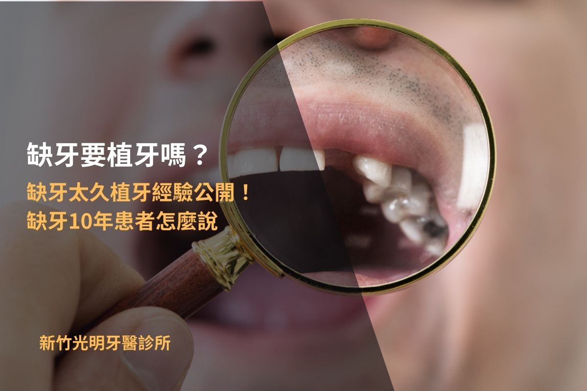 Read more about the article 缺牙要植牙嗎？缺牙太久植牙經驗公開！缺牙10年患者怎麼說