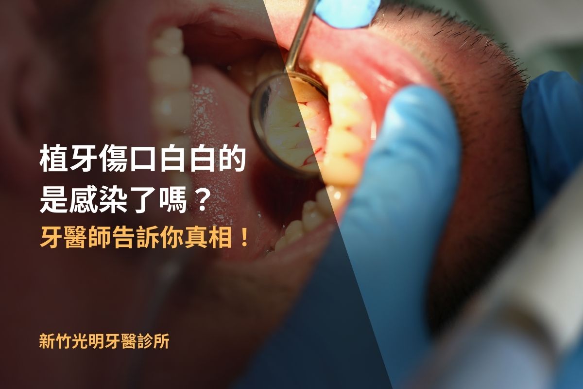 Read more about the article 植牙傷口白白的，是感染了嗎？牙醫師告訴你真相！