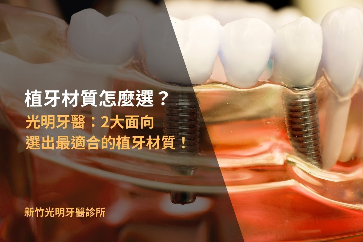 Read more about the article 植牙材質怎麼選？光明牙醫：2大面向選出最適合的植牙材質！