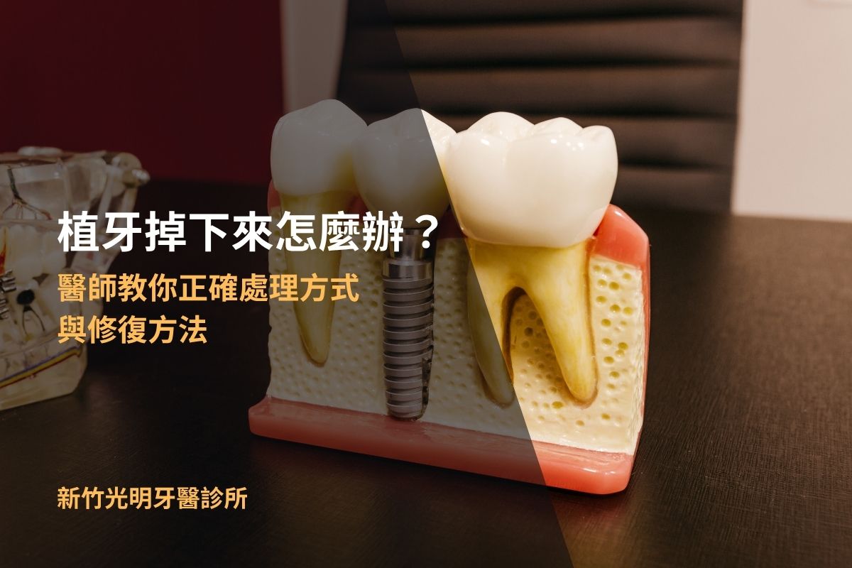 Read more about the article 植牙掉了怎麼辦？植牙掉了鎖回去還能用嗎？