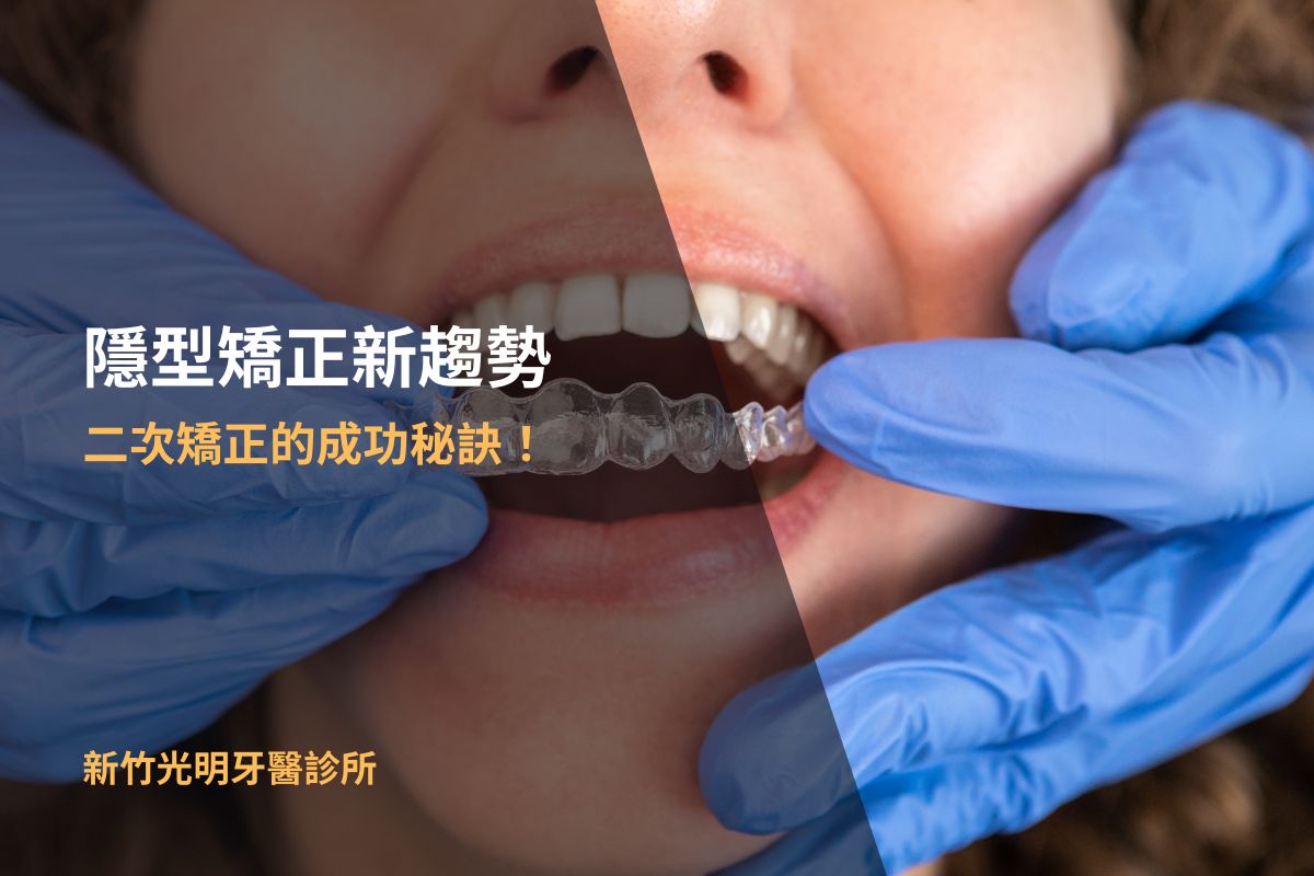 隱型矯正新趨勢