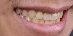 drbrian-implant-case1-small