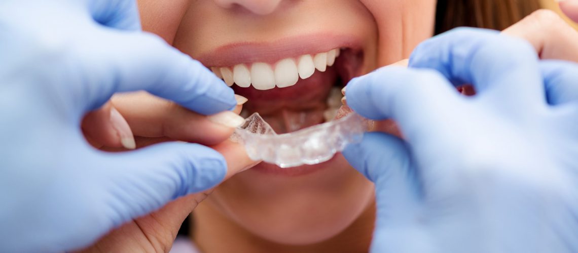 invisible-braces-2021-08-26-22-28-12-utc (2) (1)